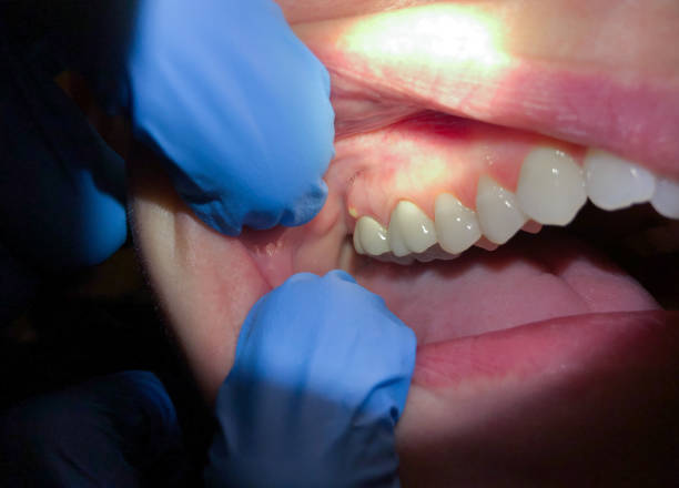Best Emergency Treatment for Toothache in Hazlehurst, GA